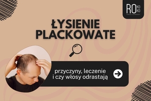 Łysienie plackowate – przyczyny, leczenie i czy włosy odrastają